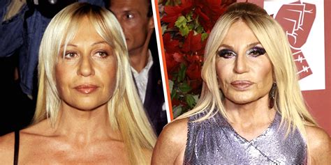 donatella versace face what happened.